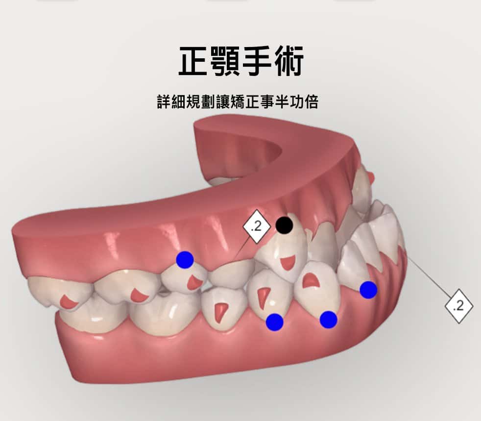 正顎手術