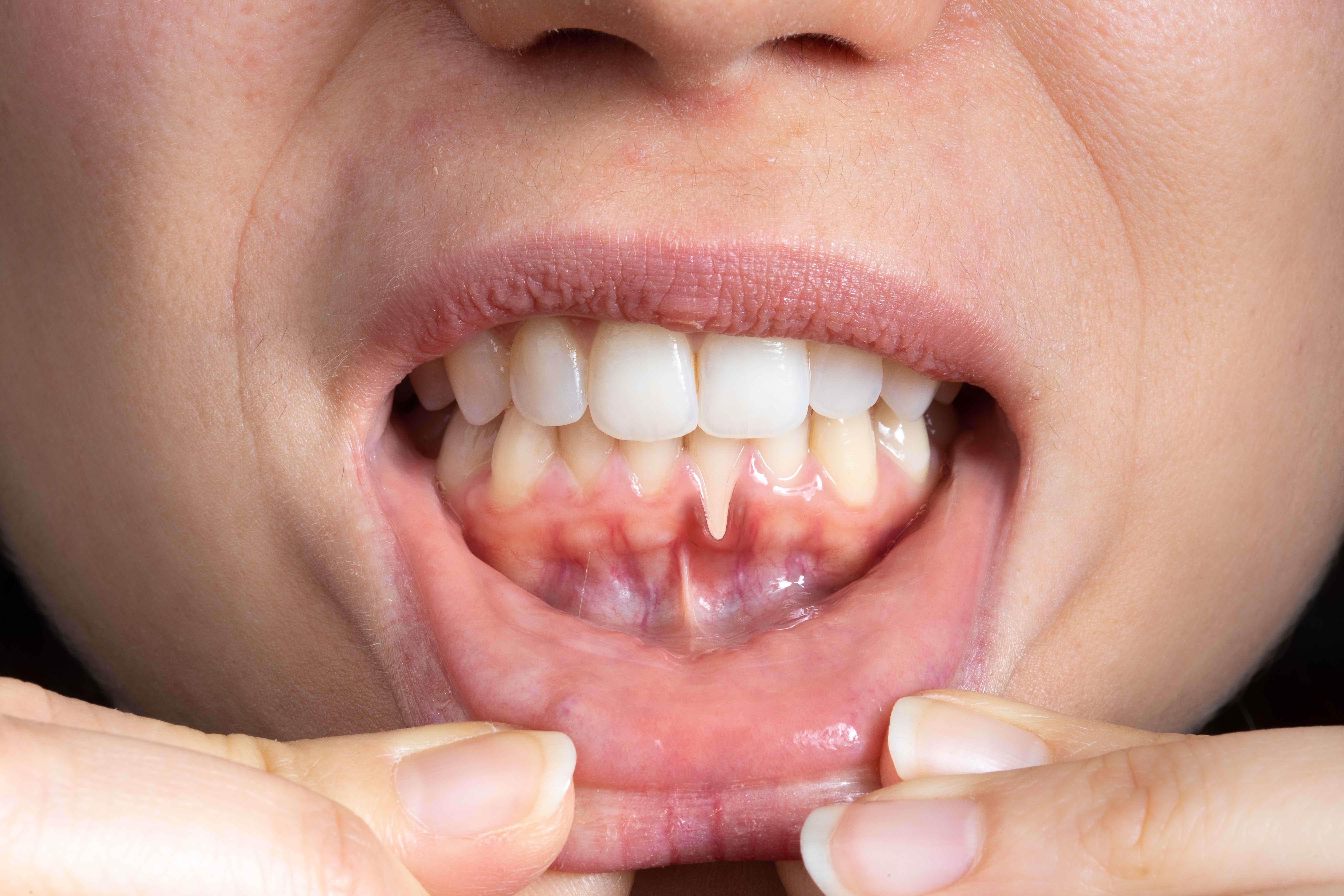 牙齦萎縮如何救